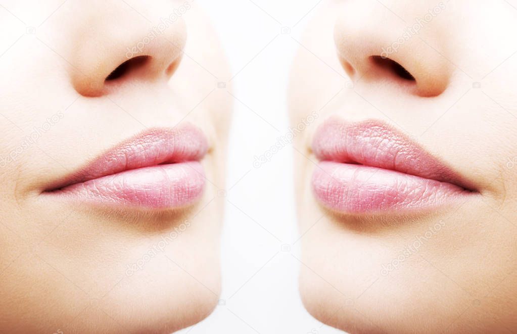 Before and after lip filler injections. 