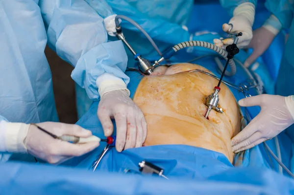 Laparoskopik ekipman kullanarak işlemi