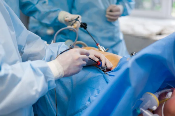 Cholecystectomy hjälp av ett endoskop Royaltyfria Stockbilder
