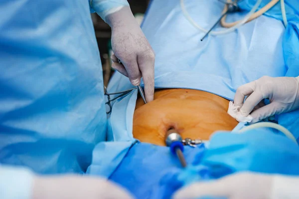 Operación con endoscopia en ginecología — Foto de Stock