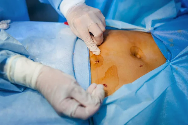 Operación con endoscopia en ginecología —  Fotos de Stock