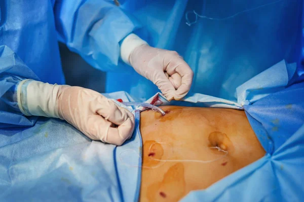 Operação com endoscopia em ginecologia — Fotografia de Stock
