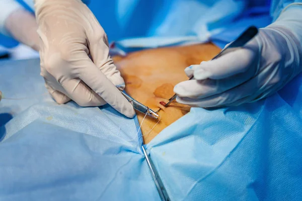 Operation using endoscopy in gynecology — Stock Photo, Image
