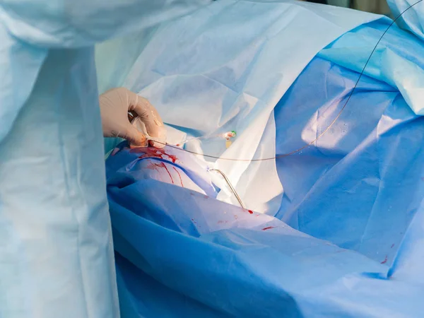 Tratamento de doenças vasculares com angiografia — Fotografia de Stock