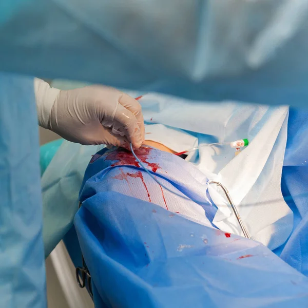 Tratamento de doenças vasculares com angiografia — Fotografia de Stock