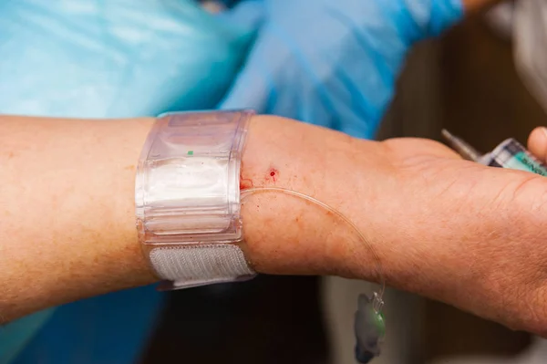 Bir kateter erişim için stent anjiyoplasti yerleşim yeri