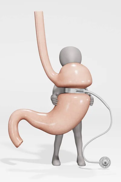 胃バンドと人間の胃と文字の3Dレンダリング — ストック写真