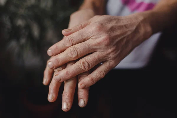 Trocknen Sie die Hände einer Frau. Hand-Hautproblem — Stockfoto