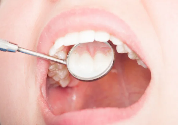 Close-up of dental mirroring in woman mouth — Stock Photo, Image