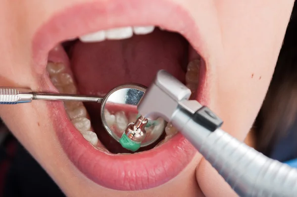 Macro tiro de escovação profissional dental com espelho dentista — Fotografia de Stock