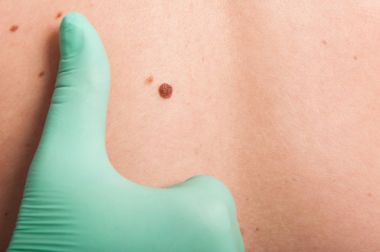 Doktor el incelemek cilt köstebek