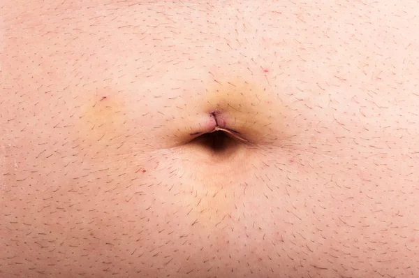 Primer plano de la puntada abdominal después de la cirugía laparoscópica — Foto de Stock