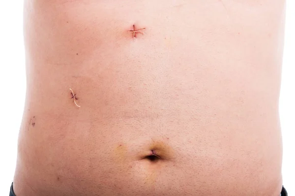 Addome maschile con punti freschi dopo la rimozione della cistifellea — Foto Stock