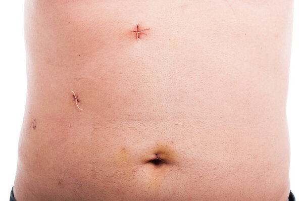Male abdomen with fresh stitches after gallbladder removal