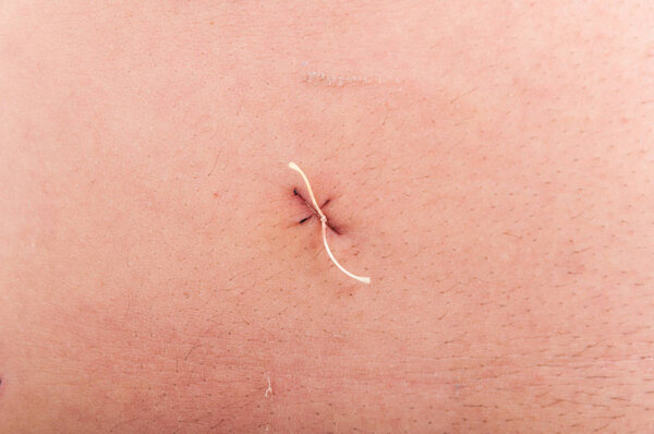 Closeup of abdominal stitch after laparoscopic surgery