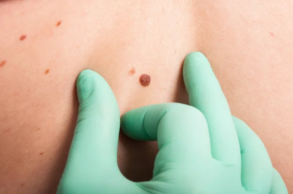 Dermatologo mano ispezione talpa della pelle — Foto Stock