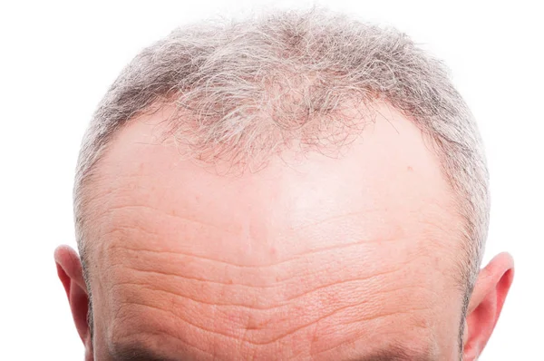 Perda de cabelo frontal como conceito de problema médico masculino — Fotografia de Stock