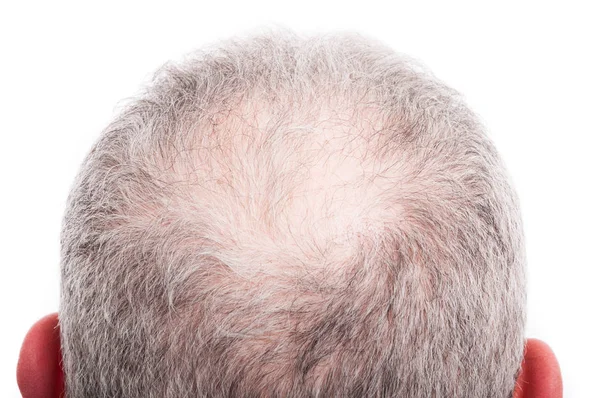 Man scalp with hair loss problem — Stock Photo, Image