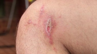 İrritan Kontakt Dermatit, adam bacak, yakın çekim