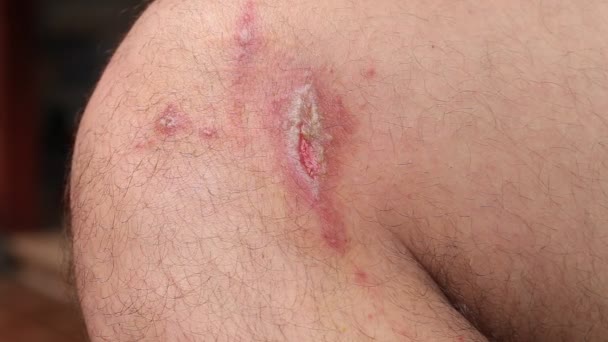 Irritant contact dermatitis at man leg, close up — Stock Video