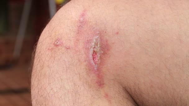 Dermatite de contact irritante à la jambe de l'homme, gros plan — Video