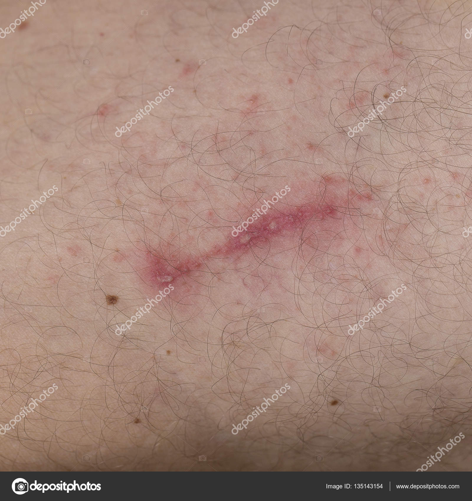 Dermatit ile temas. Tedavisi Dermatit ile temas. Tedavisi