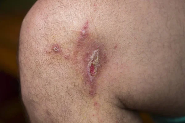 Dermatitis de contacto irritante en la pierna del hombre, primer plano . — Foto de Stock