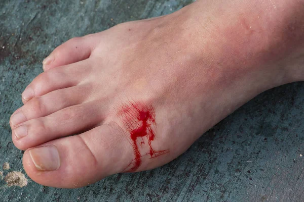 Plaie incisée sur la jambe d'une femme — Photo