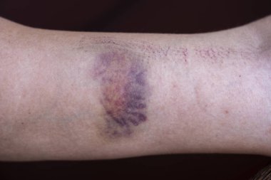 Purple bruise on the skin on a woman hand clipart
