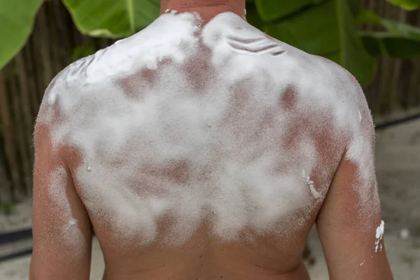 Hombre Quemado Por Sol Con Espuma Refrescante Espalda Hombre Tiene — Foto de Stock