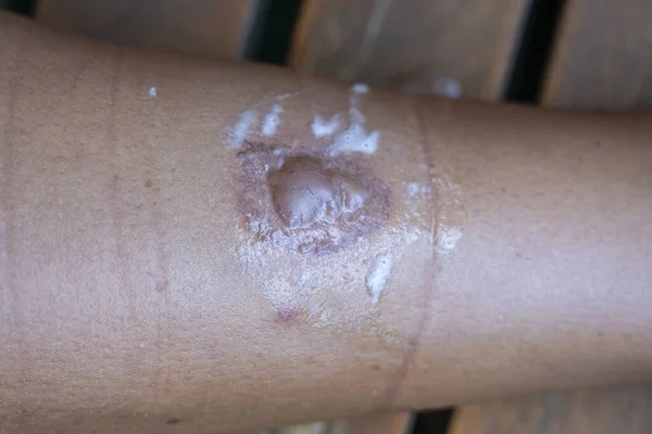 一个年轻女人腿上的皮肤被烧伤了 靠近点 受伤是在接触摩托车的热排气管时造成的 — 图库照片