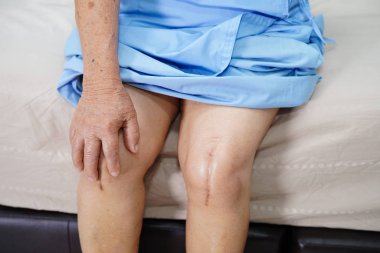 Asyalı yaşlı ya da yaşlı kadın hasta yaralarını gösteriyor. Diz eklemi ameliyatıyla değiştirilmiş. Hemşirelik hastanesi koğuşunda yatağın üzerine eklem iltihabı yapılmış.