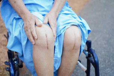 Asyalı yaşlı ya da yaşlı kadın hasta yaralarını gösteriyor. Diz eklemi ameliyatıyla değiştirilmiş. Hemşirelik hastanesi koğuşunda yatağın üzerine eklem iltihabı yapılmış.