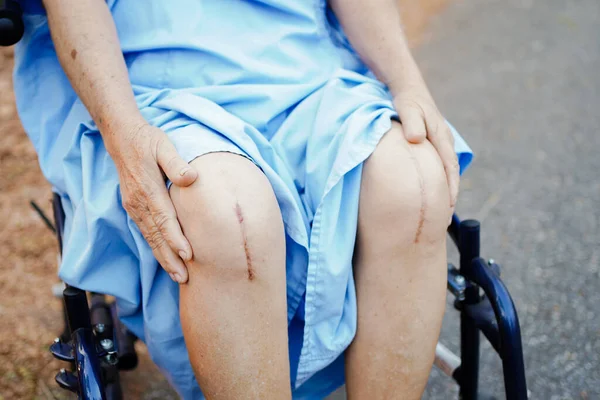 Asiatiska Äldre Eller Äldre Kvinna Patient Visar Sina Ärr Kirurgisk — Stockfoto
