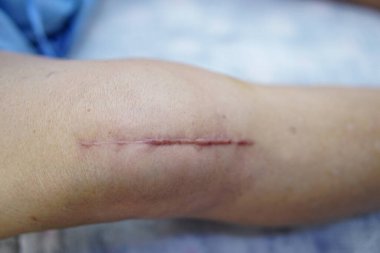 Asyalı yaşlı ya da yaşlı kadın hasta yaralarını gösteriyor. Diz eklemi ameliyatıyla değiştirilmiş. Hemşirelik hastanesi koğuşunda yatağın üzerine eklem iltihabı yapılmış..