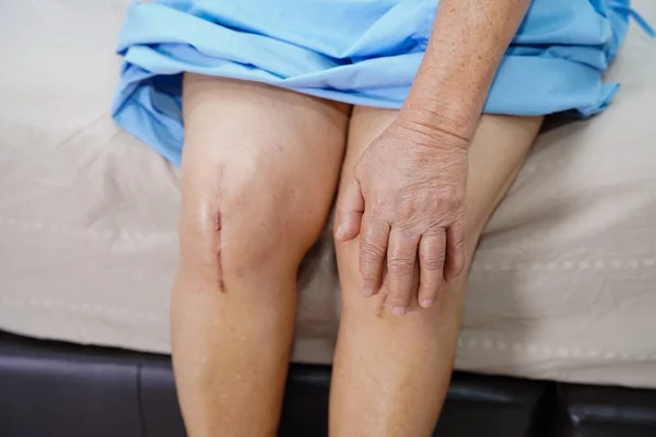 Aziatische Senior Oudere Oude Dame Vrouw Patiënt Tonen Haar Littekens — Stockfoto