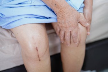 Asyalı yaşlı ya da yaşlı kadın hasta yaralarını gösteriyor. Diz eklemi ameliyatıyla değiştirilmiş. Hemşirelik hastanesi koğuşunda yatağın üzerine eklem iltihabı yapılmış..