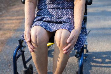 Asyalı yaşlı ya da yaşlı kadın hasta yaralarını gösteriyor. Diz eklemi ameliyatıyla değiştirilmiş. Hemşirelik hastanesi koğuşunda yatağın üzerine eklem iltihabı yapılmış..