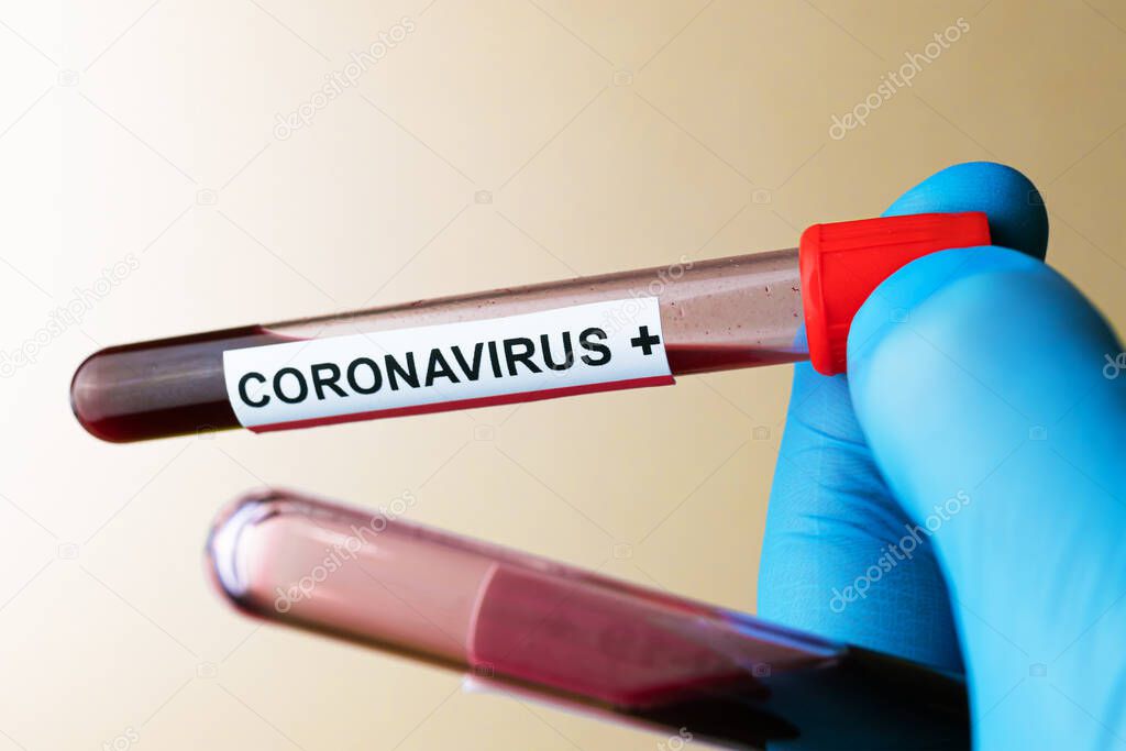 Hand in glove hold positive blood test result for the new rapidly spreading Coronavirus,