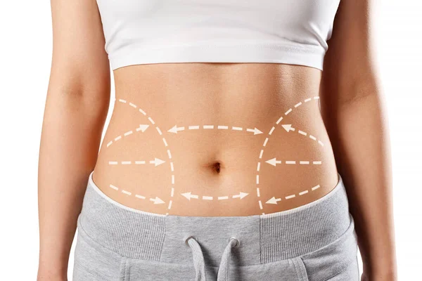 Karnında izler olan bir kadın cesedi. Liposuction, karın bölgesindeki fazla yağın cerrahi yolla alınması.