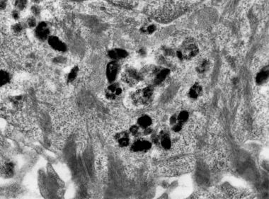 Melanin granülleri cilt hücresinde, Tem