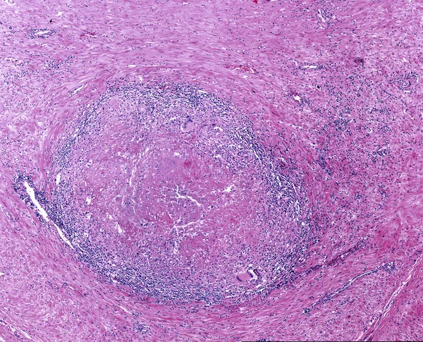 Granuloma della tubercolosi. Cellula di Langhans — Foto Stock