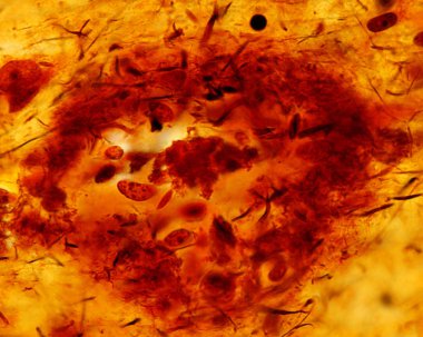 Senil plaklar. Alzheimer hastalığı