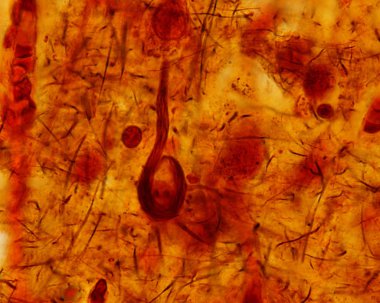 Alzheimer hastalığı