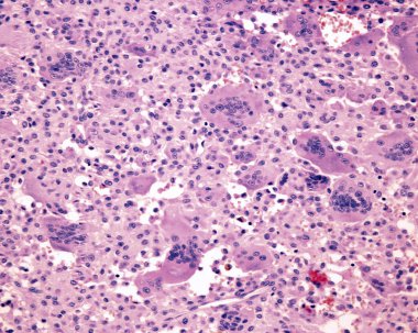 Multinucleated dev hücreler