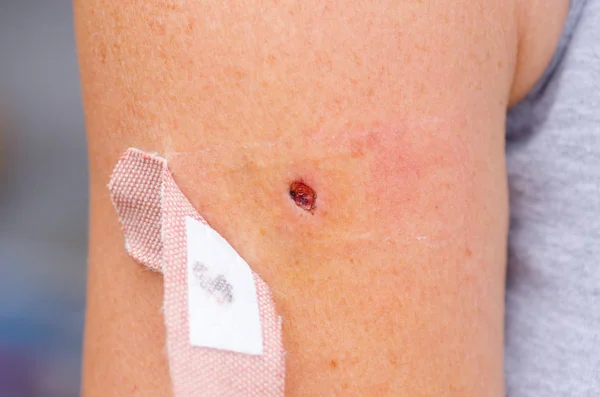 Bloody scab wound and band aid on skin — Stock Photo, Image