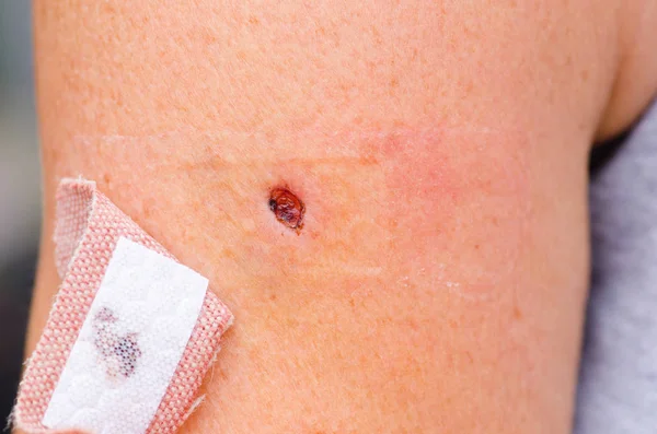 Sanguinolenta herida de costra y tirita en la piel — Foto de Stock