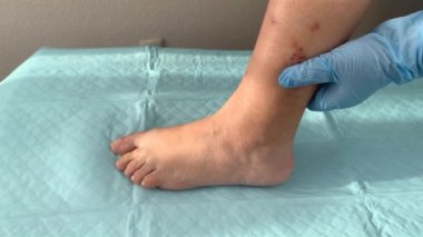Doktor, hemşire, mavi eldivenli, kadın bacağındaki yarayı ilaçla, tıbbi konseptle sarmış.