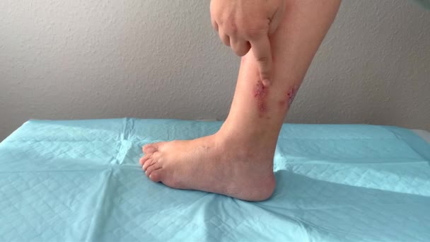 Mujer Muestra Una Herida Pierna Tratamiento Herida Disparo Cámara Lenta — Vídeo de stock