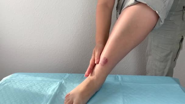 女性は足に創傷治療をしています スローモーション撮影 — ストック動画